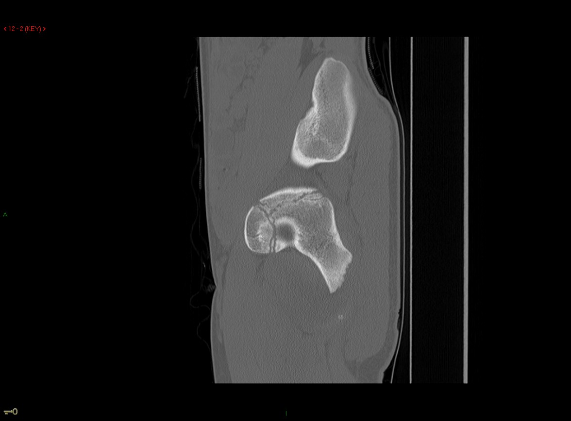 Figure 4 for case Ischial tuberosity ( RID2550 ) avulsion